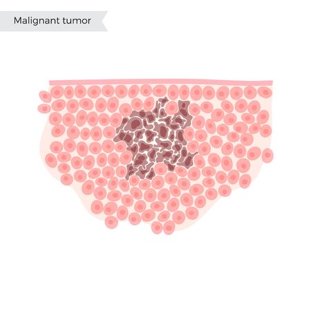 Vector isolated illustration of malignant tumor in healthy tissue. Spreading of cancer cells, tumor development. Medical infographic for poster, educational, science and medical use.のイラスト素材