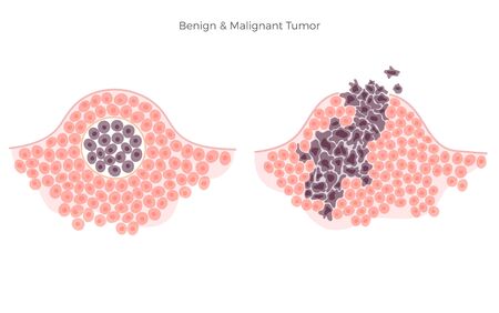 Vector isolated illustration of malignant and benign tumor in healthy tissue. Spreading of cancer cells, tumor development. Medical infographics for poster, educational, science and medical use.のイラスト素材
