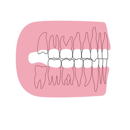 Vector isolated illustration of human wisdom tooth in gum anatomy. Human jaws model with molar teeth row. Dentistry and dental surgery concept. Flat vector illustration on whiteのイラスト素材