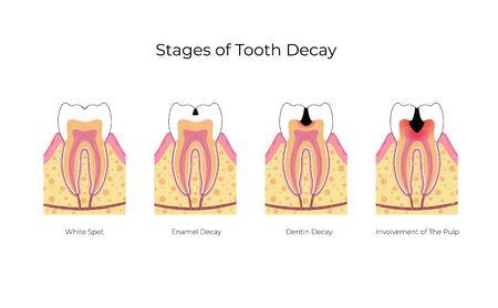 Vector isolated illustration of tooth with caries. Stages of teeth decay development medical poster. Banner for dentist office, dentistry clinic. Enamel and dentin decayのイラスト素材