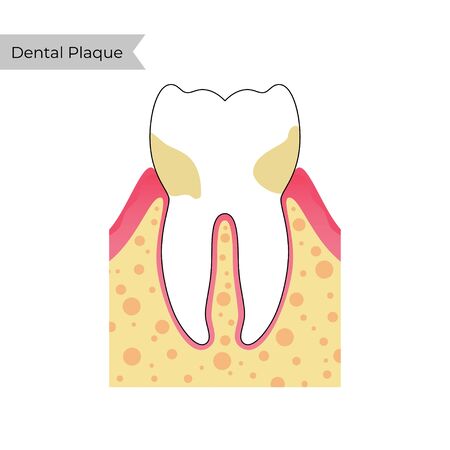 Vector isolated illustration of dental plaque with inflammation. Tooth anatomy infographics. Medical banner or poster illustration.のイラスト素材