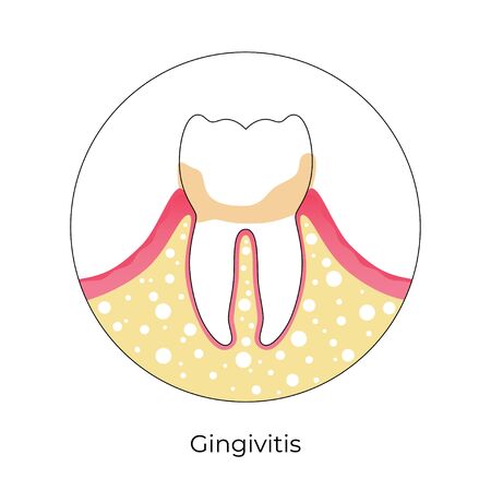 Vector flat isolated illustration of tooth with gingivitis. Teeth anatomy infographics. Medical banner or poster illustration. Dental problem. Medical Oral Health. Template of Periodontal Disease のイラスト素材