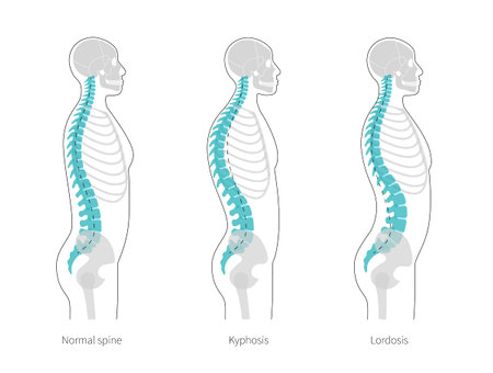 Kyphosis, lordosis flat vector illustration.