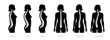 Spinal deformity flat vector illustrationのイラスト素材