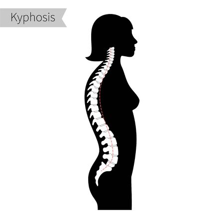Kyphosis flat vector illustration.のイラスト素材
