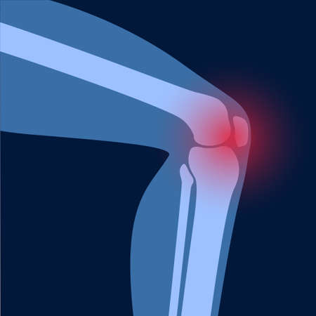 Arthritis in knee jointのイラスト素材