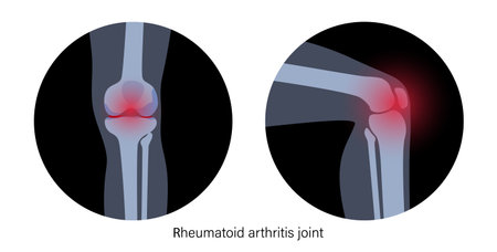Arthritis in knee jointのイラスト素材