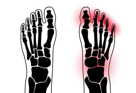 Arthritis foot conceptのイラスト素材