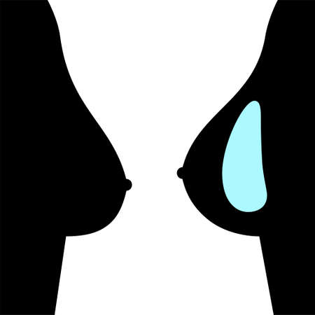 Breast Implant Conceptのイラスト素材