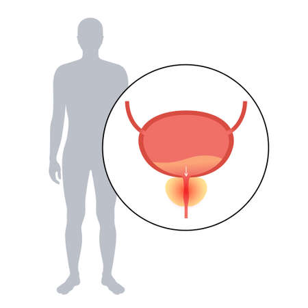 Prostatitis inflammation problemのイラスト素材
