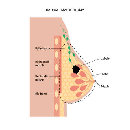 Breast disease conceptのイラスト素材