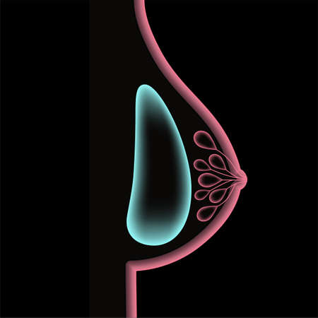 Breast Implant Conceptのイラスト素材