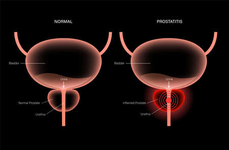 Prostatitis inflammation problemのイラスト素材