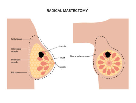 Breast disease conceptのイラスト素材