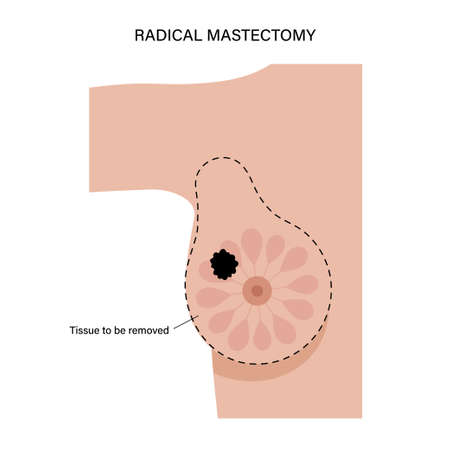 Breast disease conceptのイラスト素材