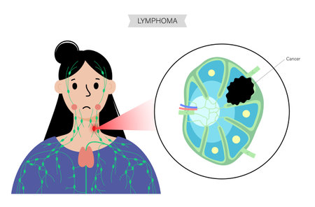 Lymphoma cancer conceptのイラスト素材