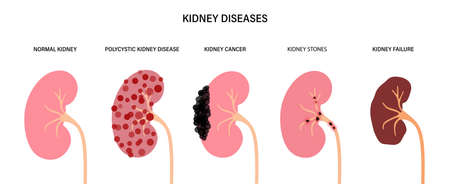 Kidney disease conceptのイラスト素材