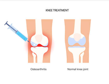 Knee Injection conceptのイラスト素材