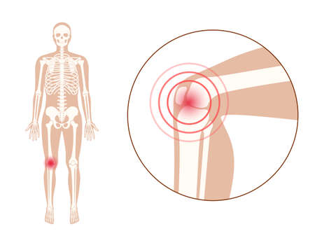 Pain in knee jointのイラスト素材