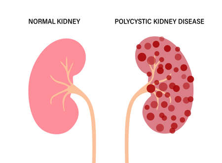Kidney disease conceptのイラスト素材