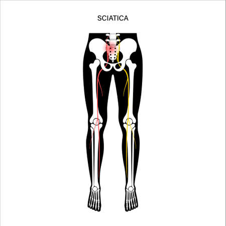 Muscular pelvis sciaticaのイラスト素材