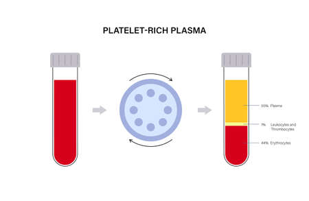 Platelet rich plasma concept illustrationのイラスト素材
