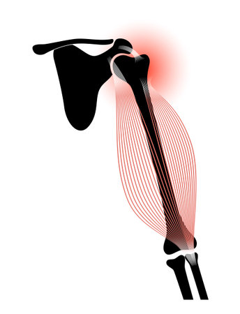 Biceps tear traumaのイラスト素材