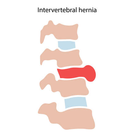 intervertebral hernia conceptのイラスト素材