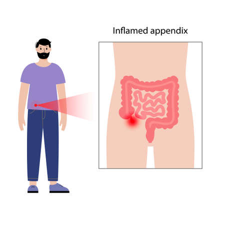 Appendix pain conceptのイラスト素材