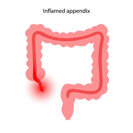 Appendix pain conceptのイラスト素材