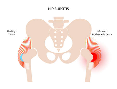 Bursitis inflammation conceptのイラスト素材