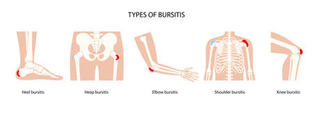 Bursitis icons setのイラスト素材