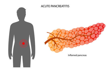 Pancreas disease and cancerのイラスト素材
