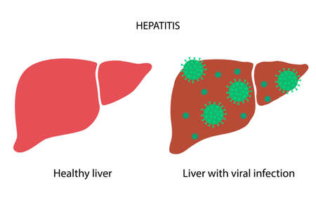 Liver disease conceptのイラスト素材