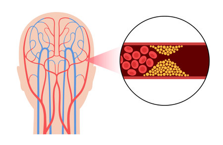 Brain stroke ishemic