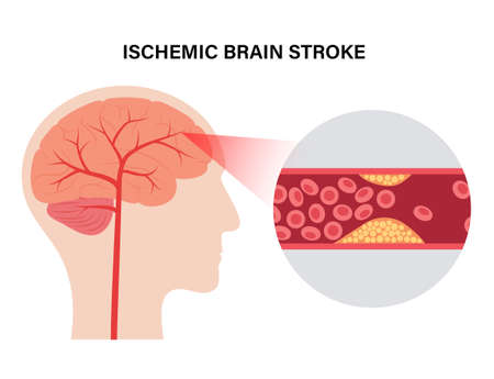 Brain stroke ishemicのイラスト素材