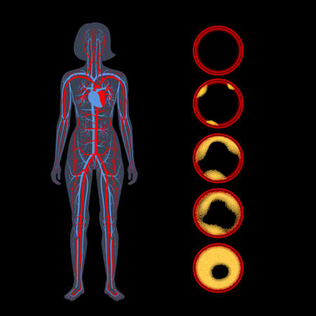 Cholesterol and atherosclerosisのイラスト素材