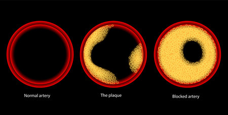 Cholesterol and atherosclerosisのイラスト素材