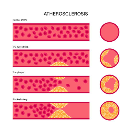 Cholesterol and atherosclerosisのイラスト素材