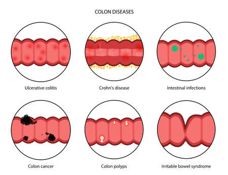 Intestines diseases conceptのイラスト素材
