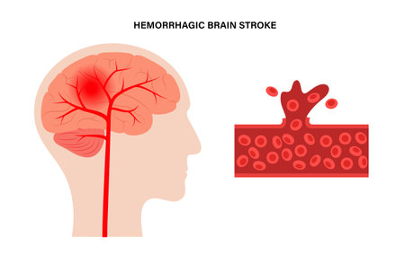 Brain stroke hemorrhagic