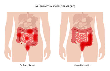Inflammatory bowel diseaseのイラスト素材