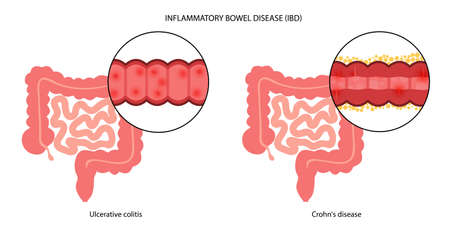 Inflammatory bowel diseaseのイラスト素材