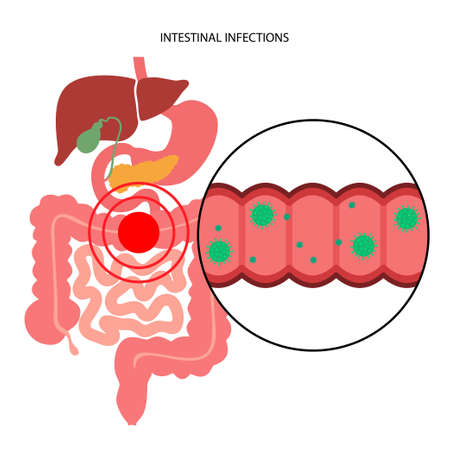 Intestinal infections diseaseのイラスト素材
