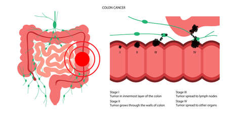 Colon cancer stageのイラスト素材