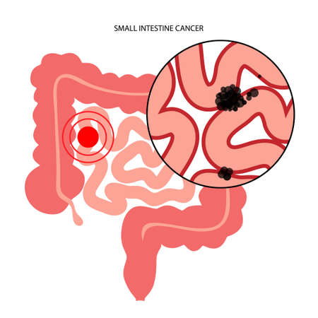 Small intestine cancerのイラスト素材