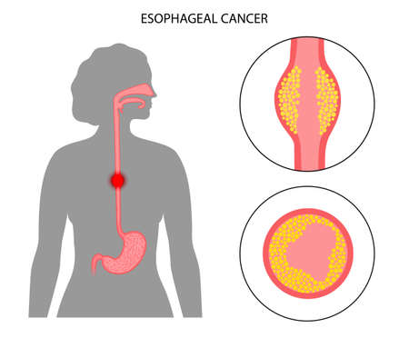 esophageal cancer conceptのイラスト素材