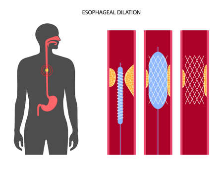 Esophageal dilation procedureのイラスト素材