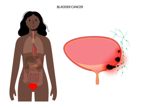Bladder cancer stagesのイラスト素材