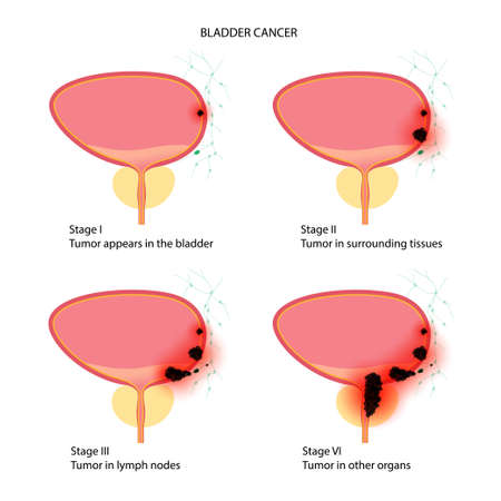 Bladder cancer stagesのイラスト素材